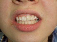 После восстановления зуба при помощи реставрации - Стоматолог из Москвы - Комин Геннадий