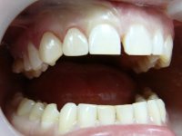 После реставрации зубов - Стоматолог из Москвы - Комин Геннадий